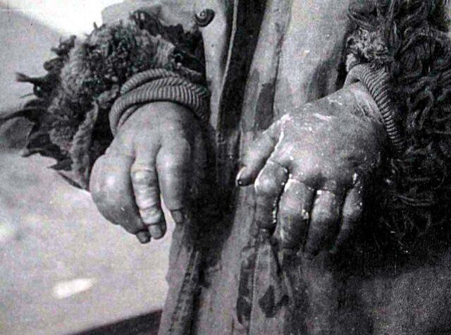 Close-up of frostbitten hands
